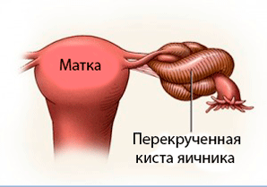 Как узнать, что возникло перекручивание ножки кисты яичника